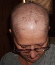 My Journey with Breast Cancer