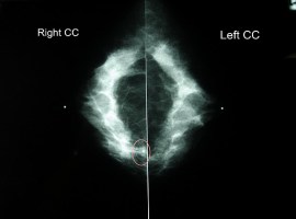 Beating Breast Cancer- My Story