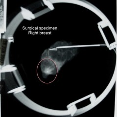 Beating Breast Cancer- My Story